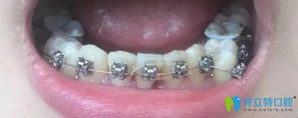 三個(gè)月的時(shí)間下牙排齊了