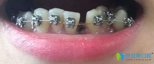 拔了一顆下牙后戴牙套的圖片