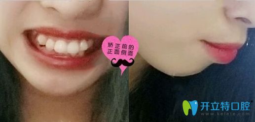 分享我在深圳潤澤瑞尼絲口腔做齒性齙牙矯正的前后效果