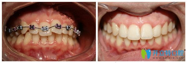 LH魔幻記憶矯正技術(shù)前后對比圖