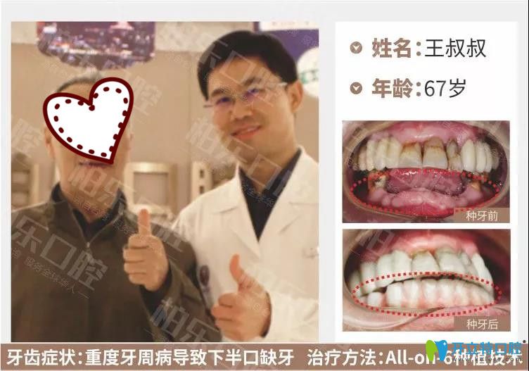 南寧柏樂(lè)口腔半口種植牙案例