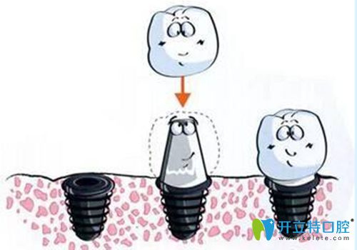 種植牙掉了還能再種嗎，來深扒導(dǎo)致種植牙失敗的主要原因