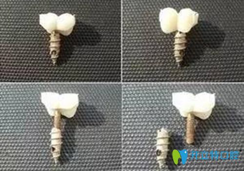 種植牙維護(hù)不好會導(dǎo)致使用時間減短