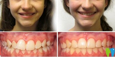 好佰年口腔牙齒深覆頜矯正前后對(duì)比圖