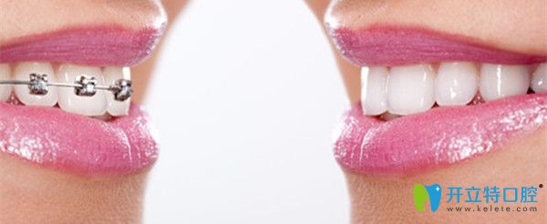 避免矯正中常見(jiàn)的誤區(qū)