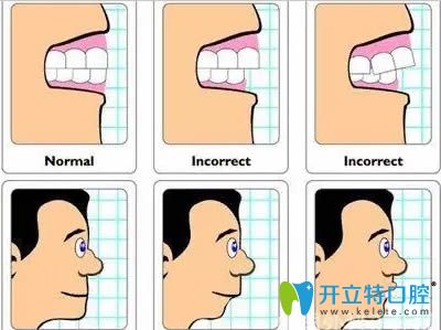 鐘紅醫(yī)生表示對(duì)于兒童錯(cuò)頜畸形應(yīng)采取早期預(yù)防和干預(yù)治療