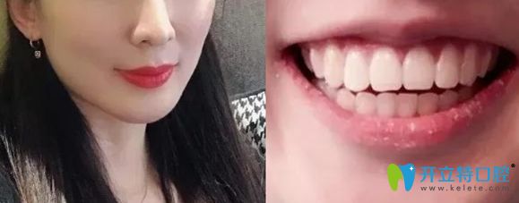 威海舒好口腔劉炳黎院長正畸案例術(shù)后照 威海舒好口腔劉炳黎院長正畸案例術(shù)后照