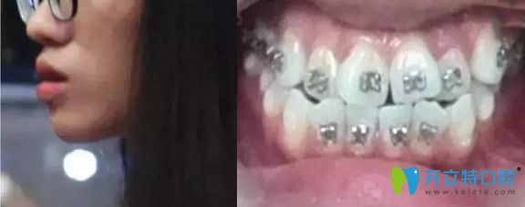 威海舒好口腔金屬托槽矯正案例術(shù)前照 威海舒好口腔金屬托槽矯正案例術(shù)前照