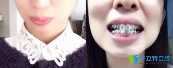 威海舒好口腔劉炳黎院長牙齒正畸案例效果 威海舒好口腔劉炳黎院長牙齒正畸案例效果