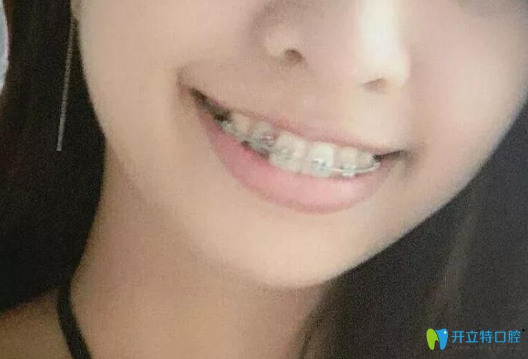 去西安醫(yī)生做正畸戴牙套30天