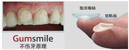陳杰講解瓷貼面優(yōu)缺點(diǎn)