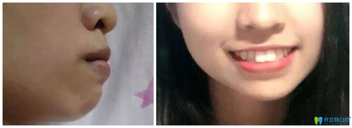 門牙前突在西安藝星做矯正22個(gè)月，下牙套后臉型變化很大