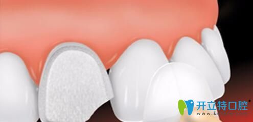西安藝星口腔陳杰主任科普：做貼面修復(fù)是選擇樹脂貼面還是瓷貼面