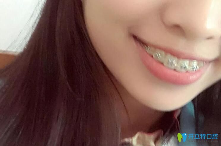 門牙前突矯正戴牙套130天