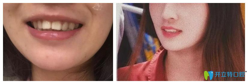 西安哪個醫(yī)院矯正牙齒比較好？來看藝星牙齒矯正案例