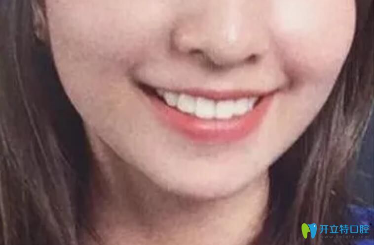 戴牙套22個月下牙套后效果圖
