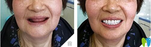 沈陽歡樂口腔種植牙案例