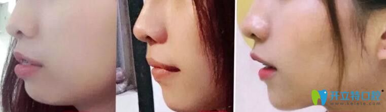 牙齒矯正左60天、中235天、右567天側臉對比變化圖