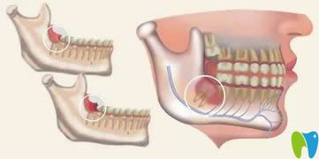 羅晶晶科普阻生齒的拔除哪種方法好