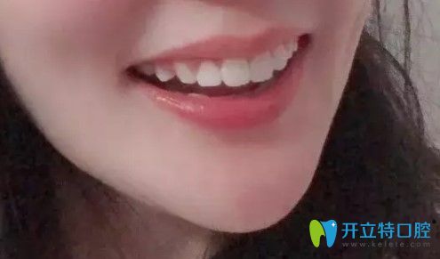 在青島諾德口腔做過齙牙矯正后的照片