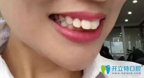 在青島諾德做完隱適美齙牙矯正后分享一份牙齒矯正價格表