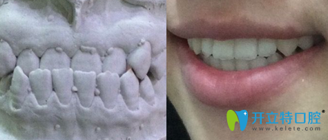 我的牙齒反頜是在上海圣康口腔戴金屬托槽牙套矯正好的！