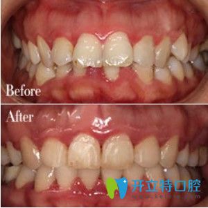 弘和口腔齙牙矯正前后圖