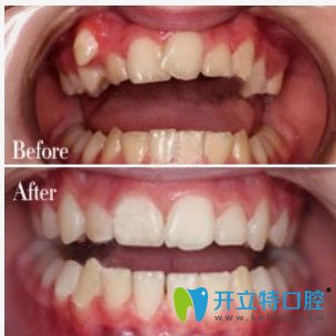 深圳弘和口腔牙列不齊矯正前后圖