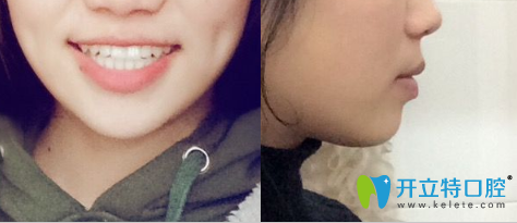 我在<!--<i data=20240703-sp></i>-->圣康口腔戴金屬托槽牙套矯正好了牙性反頜