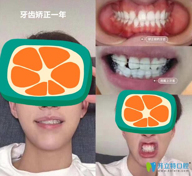 小哥哥在順德壹加壹做半隱形陶瓷矯正中牙齒變化過(guò)程圖