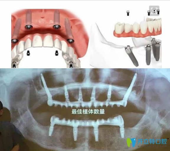 allon6種植牙圖片