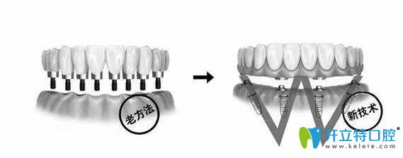 傳統(tǒng)種植和allon6種植牙區(qū)別圖