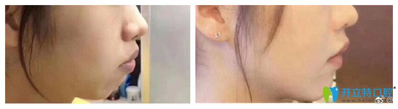 壹加壹牙齒矯正前后臉型變化圖對(duì)比效果