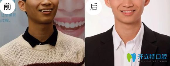 佛山春芽口腔提醒牙齒矯正對(duì)外貌影響很大