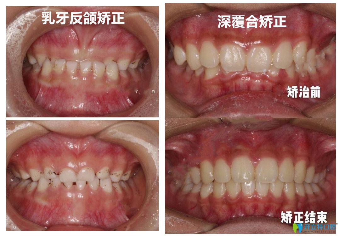 深圳美萊口腔韓旭醫(yī)生做牙齒矯正怎么樣？有案例為證哦