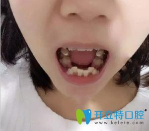 順德壹加壹口腔陶瓷托槽矯正齙牙術中照