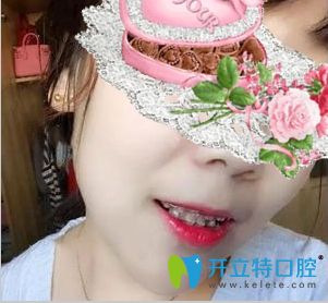 順德壹加壹口腔陶瓷半隱形牙套矯正111天照