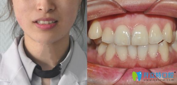 濟南正畸哪家醫(yī)院好?韓氏醫(yī)院口腔科金屬牙齒矯正就很贊!