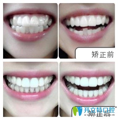 衡陽雅美口腔顧客矯正案例圖