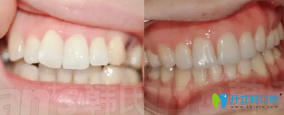 濟(jì)南韓氏口腔牙性齙牙矯正效果對(duì)比圖