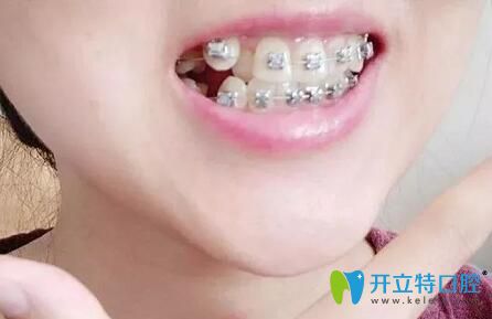 廣州壹加壹口腔戚志鋒給我做牙齒矯正第3個月