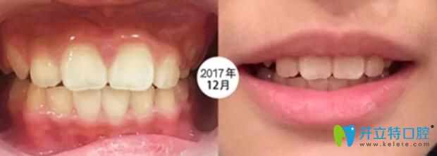 8歲的兒子在成都河馬口腔做矯正6個(gè)月 8歲的兒子在成都河馬口腔做矯正6個(gè)月