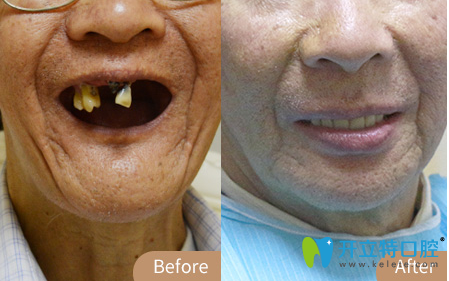 廣州柏德薛啟明醫(yī)生allon4全口種植牙案例圖 廣州柏德薛啟明醫(yī)生allon4全口種植牙案例圖