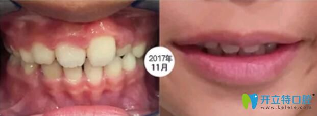 孩子在成都河馬口腔做矯正第4個(gè)月 孩子在成都河馬口腔做矯正第4個(gè)月