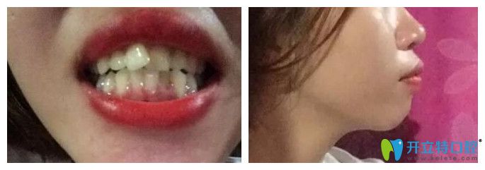 牙齒矯正可以改變臉型嗎？義烏傅氏口腔正畸經(jīng)歷來(lái)驗(yàn)證