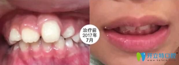  8歲兒子在成都河馬口腔做MRC肌功能矯正6個月,成功改善歪牙