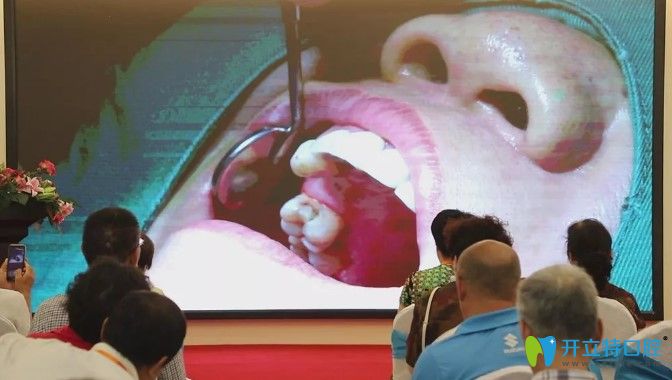 天津中諾口腔立得用種牙手術(shù)圖