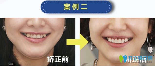 歡樂仁愛口腔虎牙矯正案例