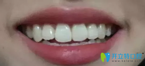 珠海九龍口腔牙性齙牙突嘴矯正兩年效果圖 珠海九龍口腔牙性齙牙突嘴矯正兩年效果圖