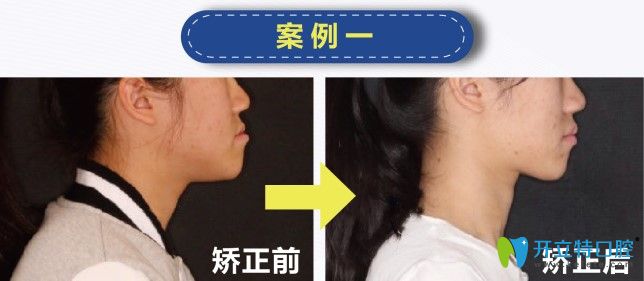歡樂仁愛口腔地包天矯正案例